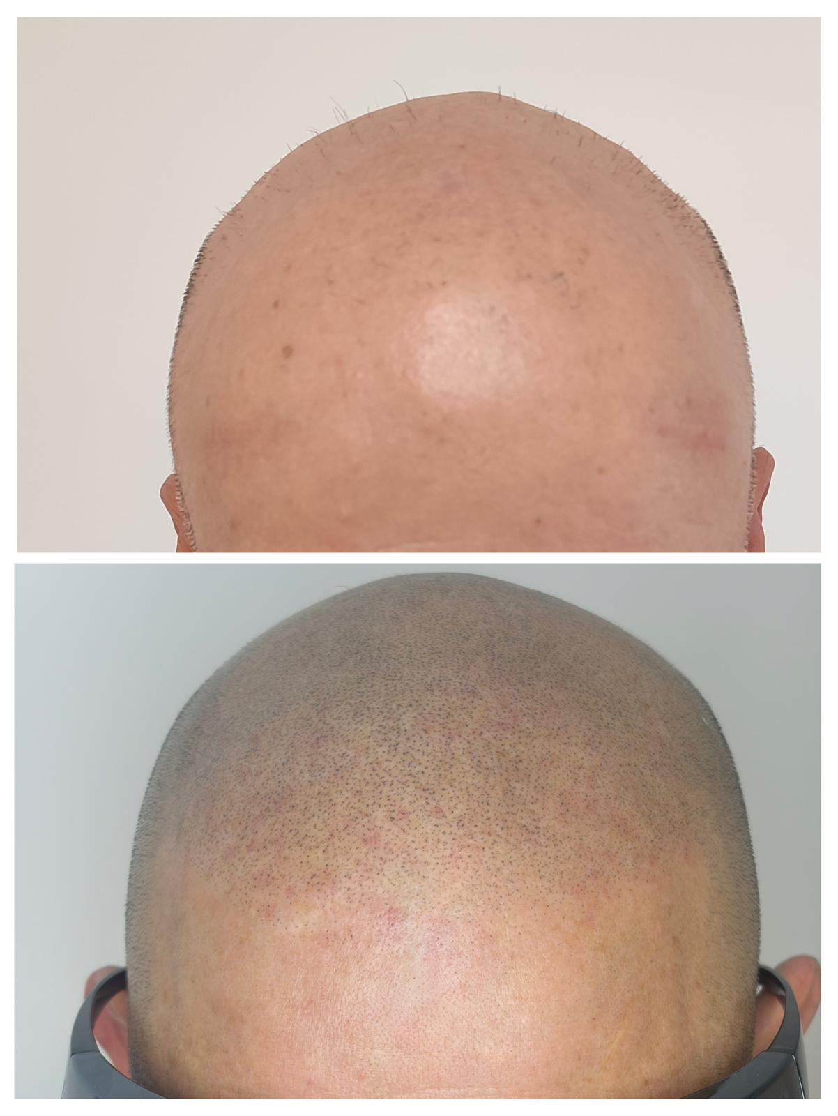 Resultado lateral antes y después