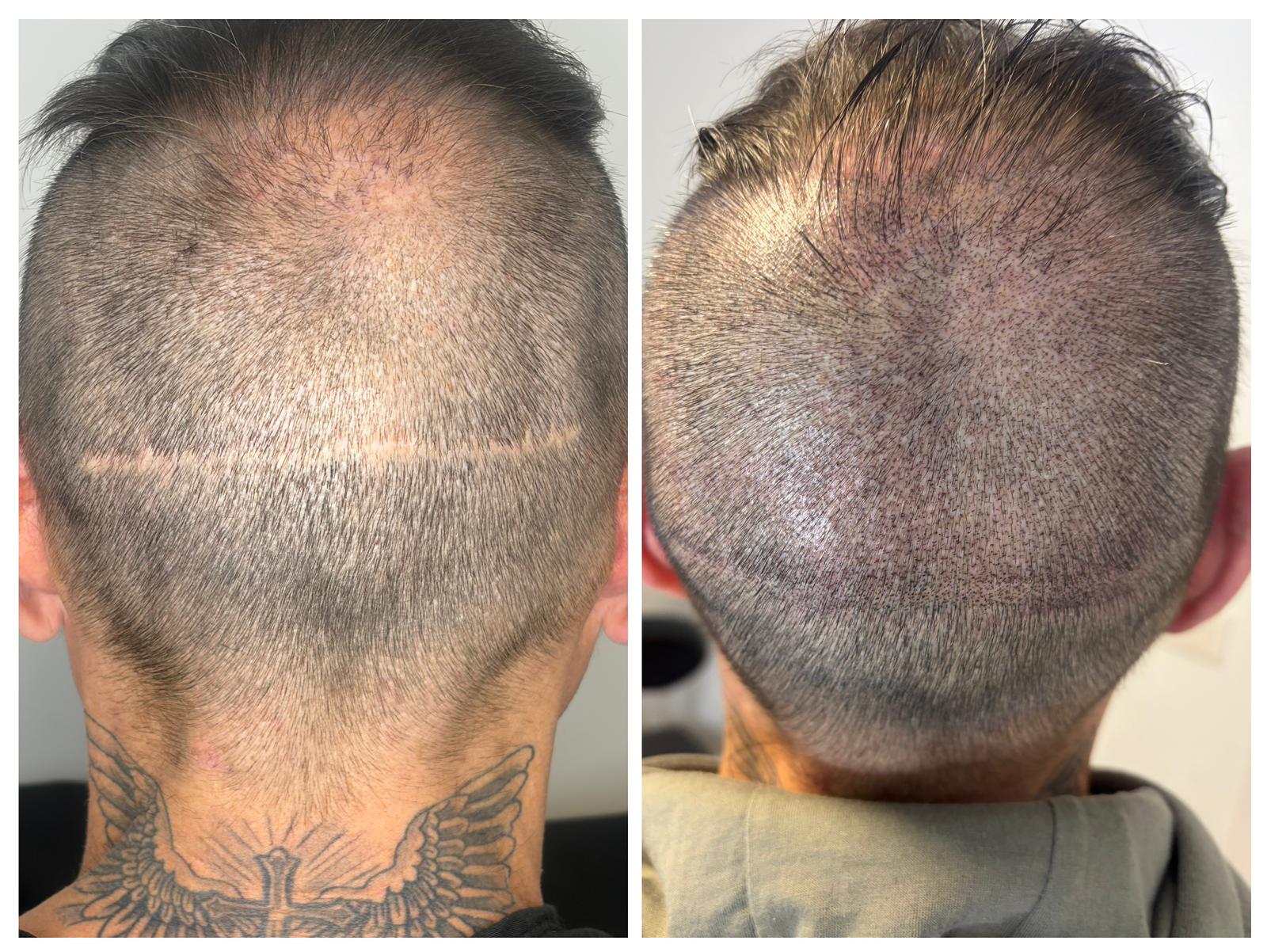 Camuflaje de cicatrices capilares