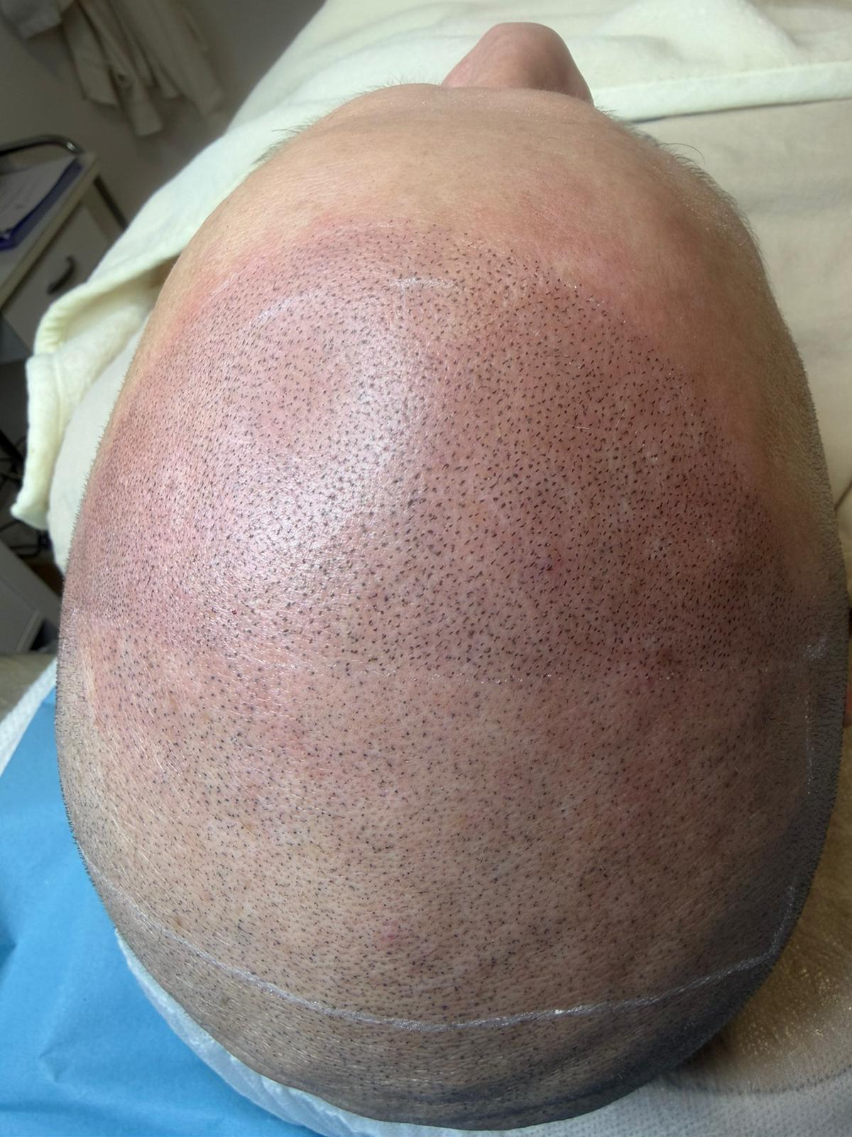 Resultado superior de micropigmentación